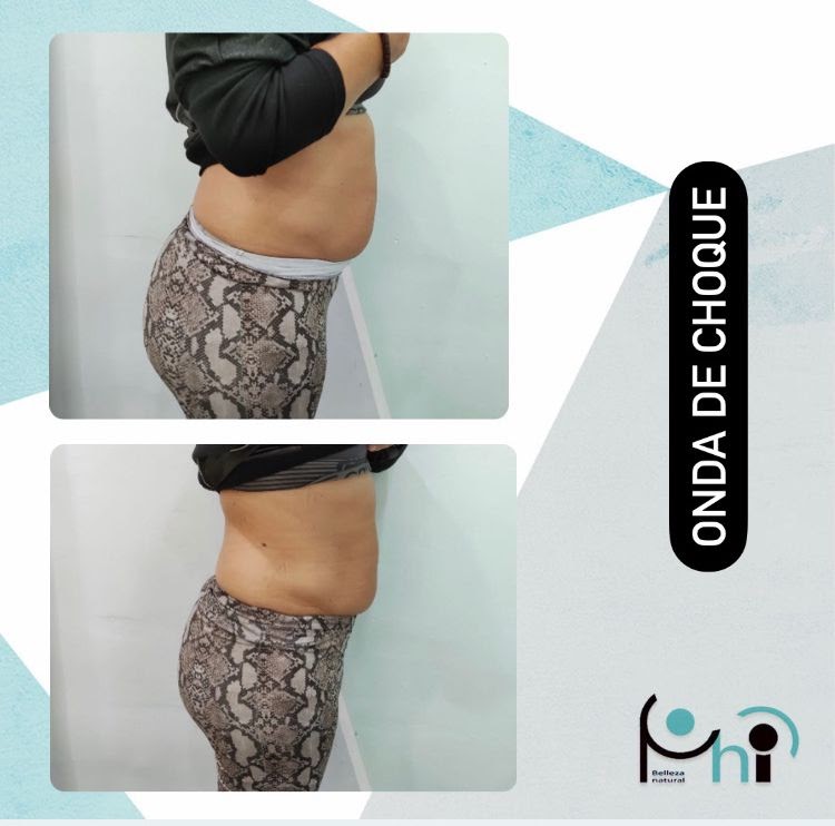 Centro de Belleza en Sevilla con tratamiento ondas de choque para reafirmar la piel