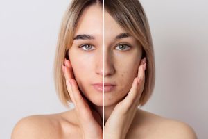 Tratamiento contra el acné en Sevilla. Centro de estética Phi Belleza Natural.