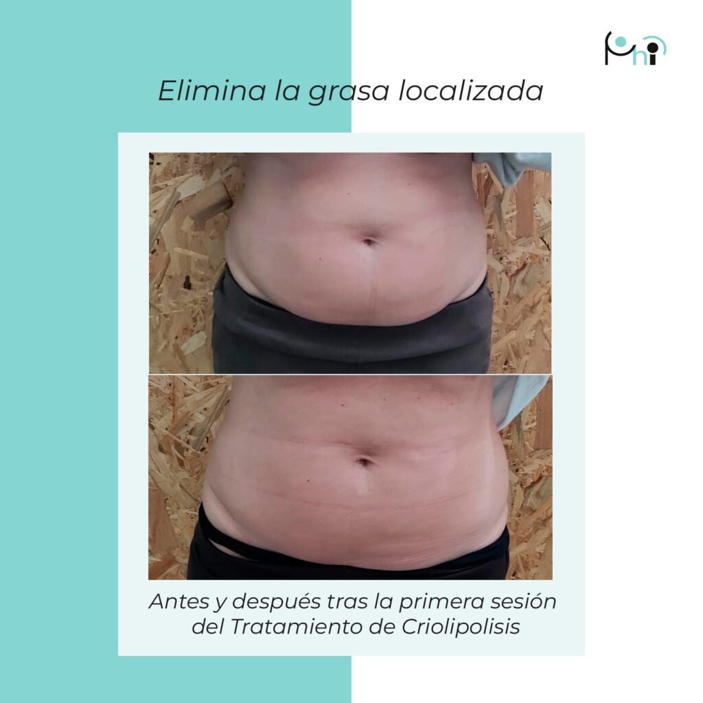 Eliminación de Grasa Localizada en Sevilla. Tratamiento de Criolipólisis Antes y Después.