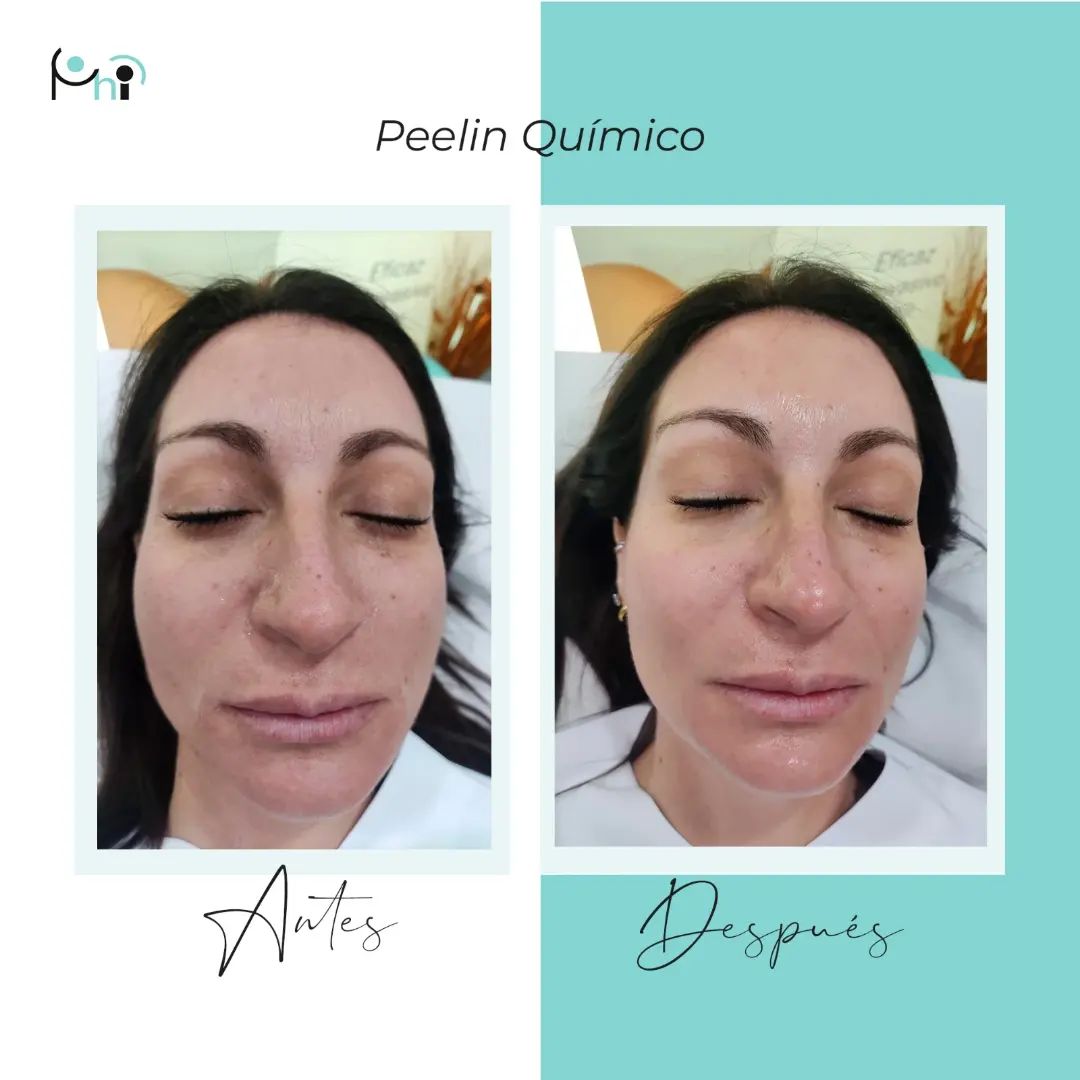 peeling quimico en sevilla