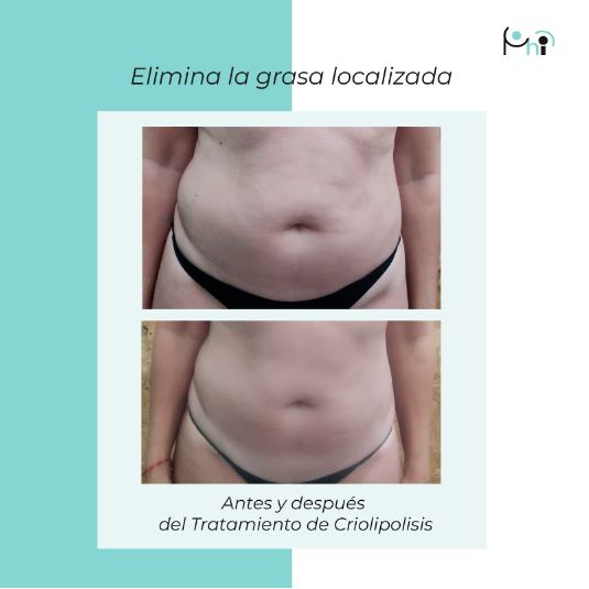 Tratamiento de Presoterapia en Sevilla. Centro Estético de Belleza Natural en Sevilla Phi.